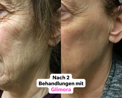 Glimora™ - Micro-Infusion Gezichtsset