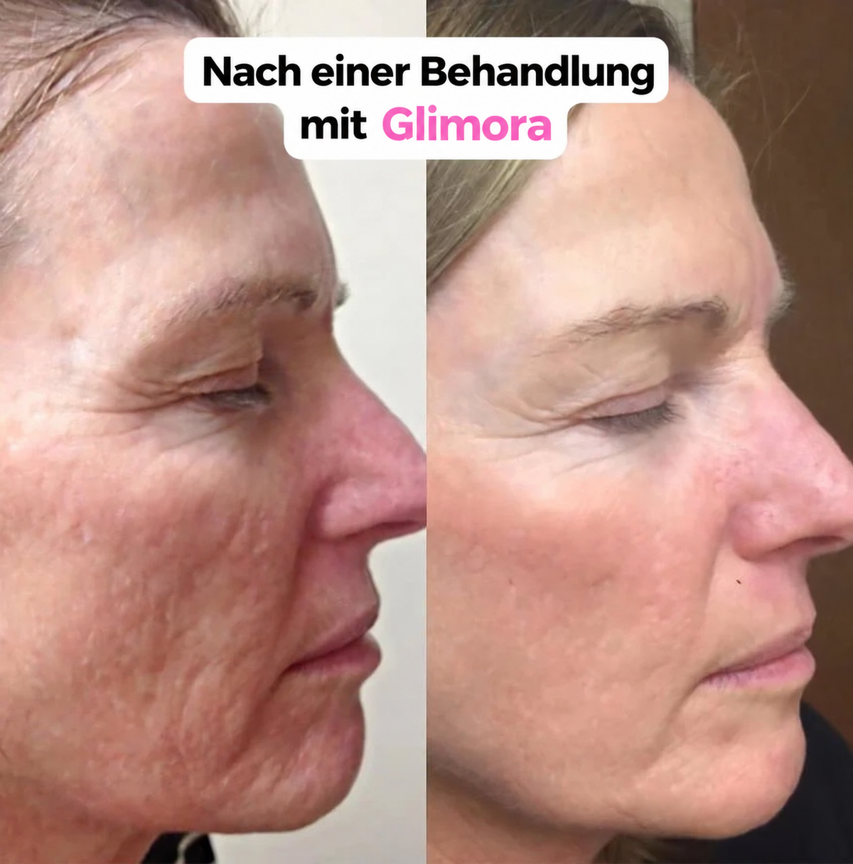 Glimora™ - Micro-Infusion Gezichtsset